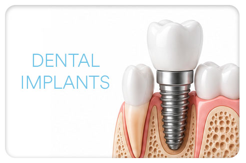 El Dorado Hills Dentist, Dr. Jason Roth, Dental Implants