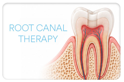 El Dorado Hills Dentist, Dr. Jason Roth, Root Canal Therapy